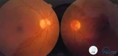 脑静脉窦狭窄放支架还能工作吗,颅内动脉支架植入术治疗血管狭窄