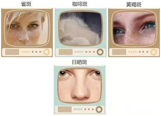 斑斑怎么护肤,解救双面斑斑