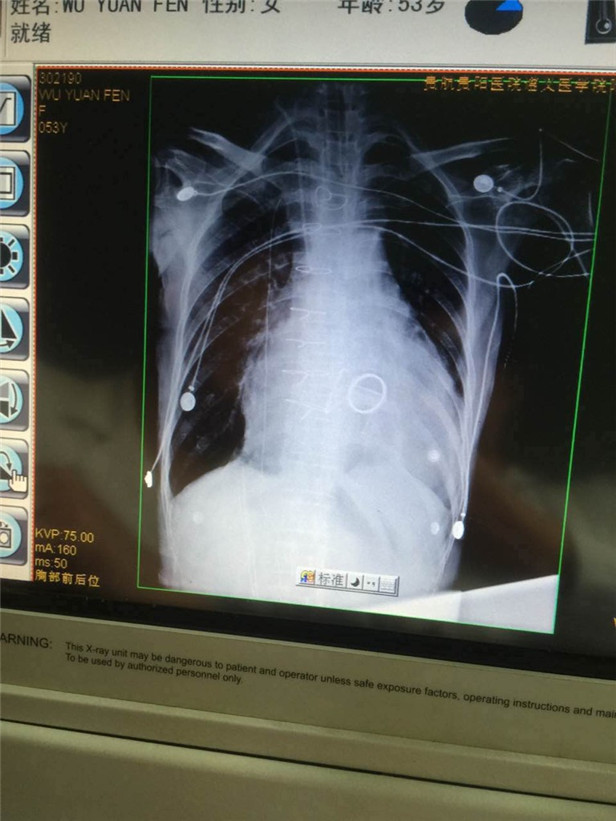 一女子突发心脏病,女子因感冒引起心脏停跳72小时