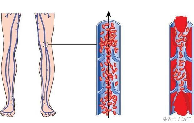 突然咳嗽出血块,突然咳血块一般什么原因导致