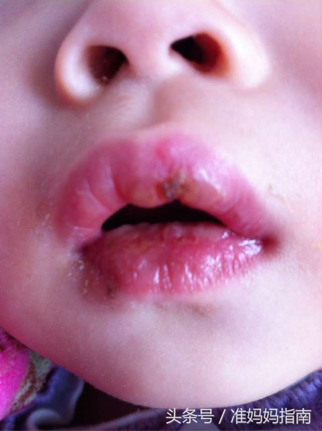 科学育儿：应对小儿口腔溃疡，给你全套方案错过别哭哈~