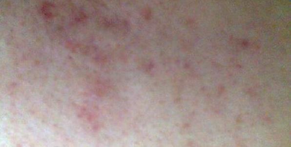 真正祛痘印最好的方法,最简单有效祛痘印的方法