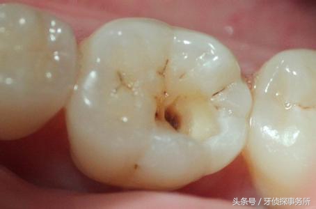 一吸凉风牙齿就酸怎么解决,一口冷风牙都会痛是怎么回事