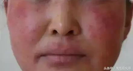 改善红血丝皮肤的良方,去红血丝的偏方秘方大全