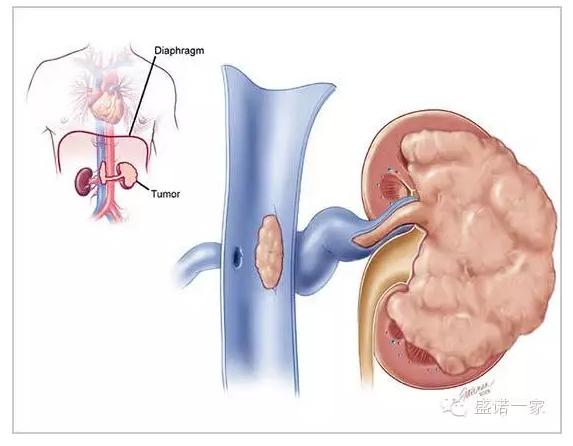 国外怎么治疗肾癌,国外治疗癌症的最新药