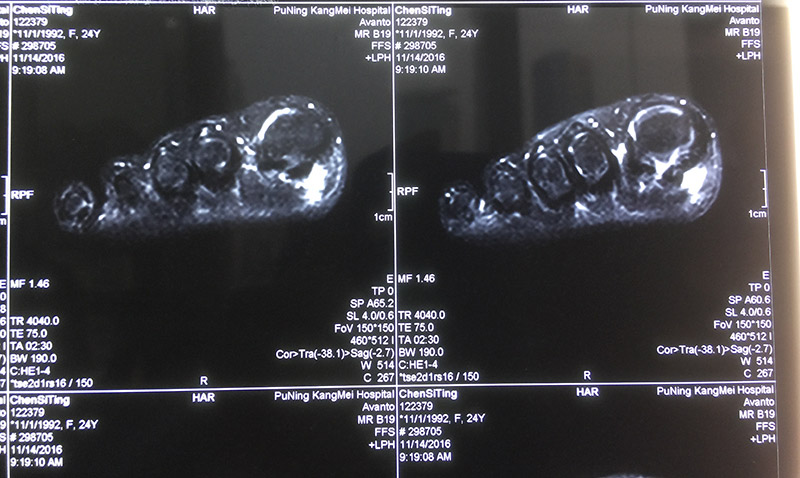 脚趾屈指肌腱的损伤,脚趾疼痛预示身体病变