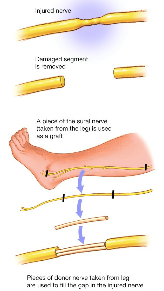 坐骨神经痛的手术治疗效果,臀肌挛缩手术损伤坐骨神经吗