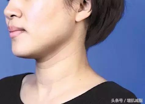 颈部衰老怎么办,颈部变老如何处理