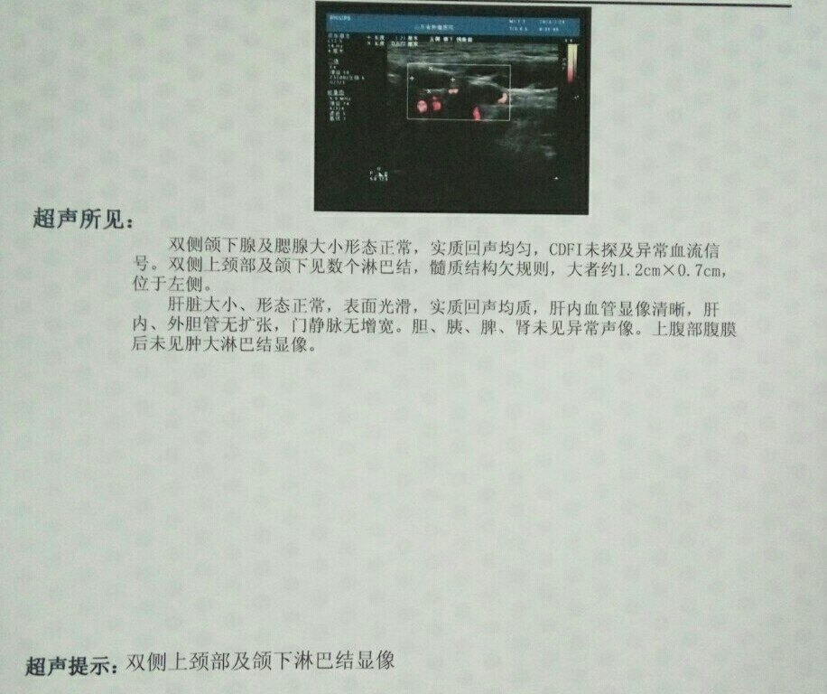 治疗舌癌的经过：小地方舌癌患者很少我只有去大医院！