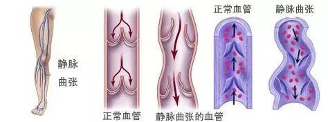 蚯蚓爬到地面上怎么回事,蚯蚓腿凸出来怎么治疗效果最好