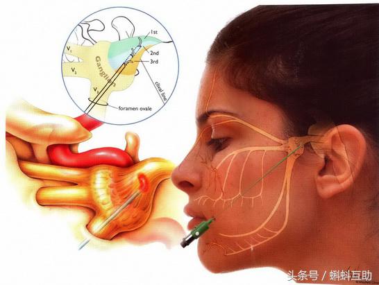 射频热凝治疗三叉神经痛动画演示,射频热凝治疗三叉神经痛痛苦吗