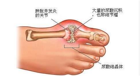 早期痛风怎么治才能断根,突然痛风一招解决