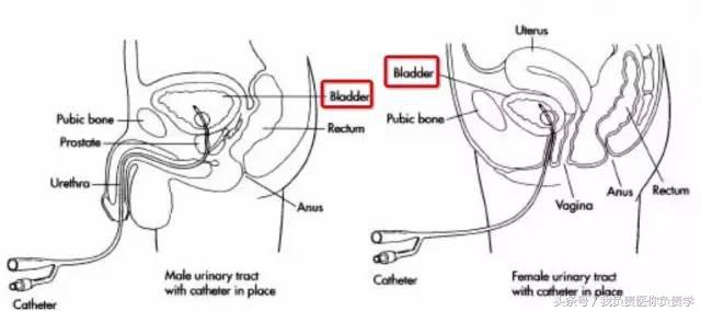 干货：留置尿管到底几天更换一次？见尿为何要再插入？