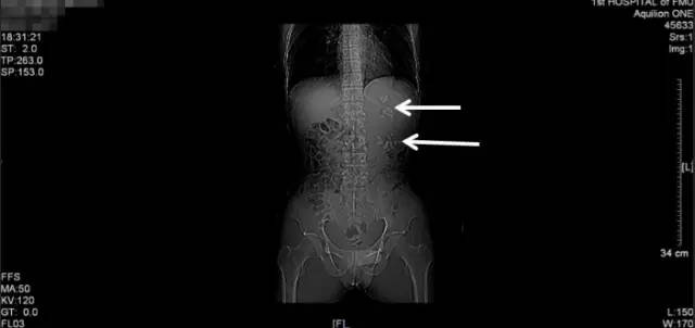 肾结石治疗最佳方案钬激光碎石,治疗肾结石案例