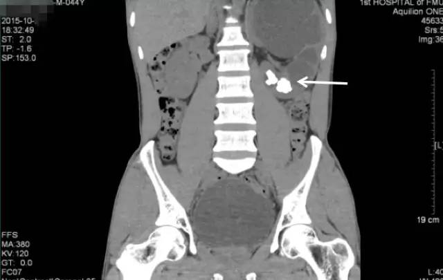 肾结石治疗最佳方案钬激光碎石,治疗肾结石案例