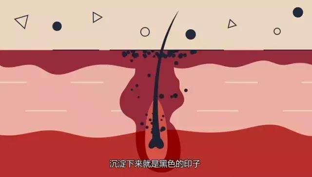 协和医院黑头清理方法,痘痘黑头粉刺医院怎么治