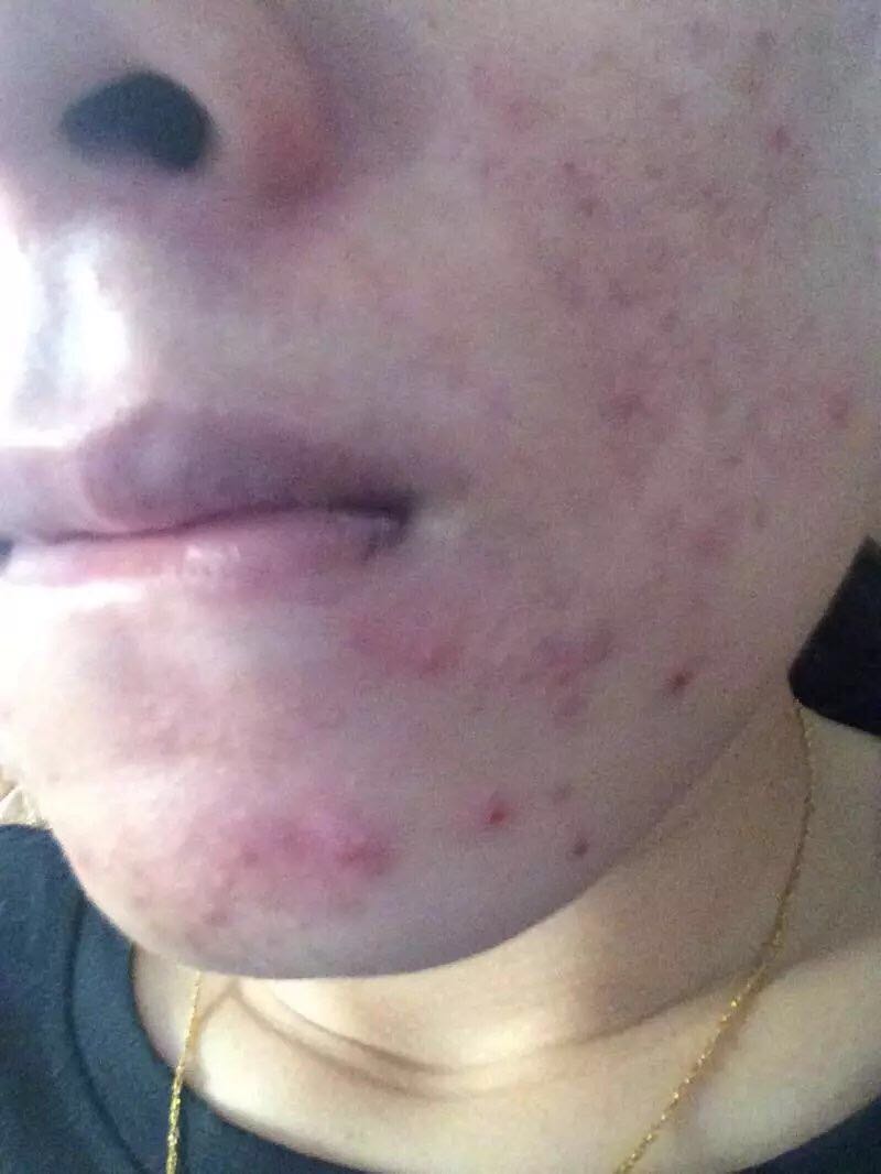 如何治疗闭口粉刺痘痘？教你一招