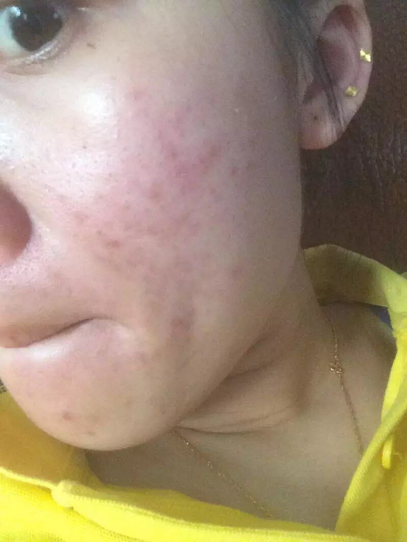 如何治疗闭口粉刺痘痘？教你一招