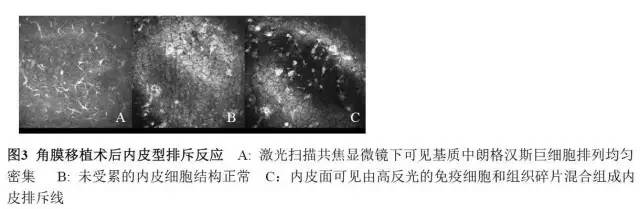 角膜内皮移植排斥反应大吗,角膜内皮移植术后的影响