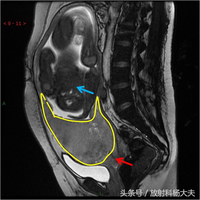 看图！胎盘跑到下面了，就是前置胎盘