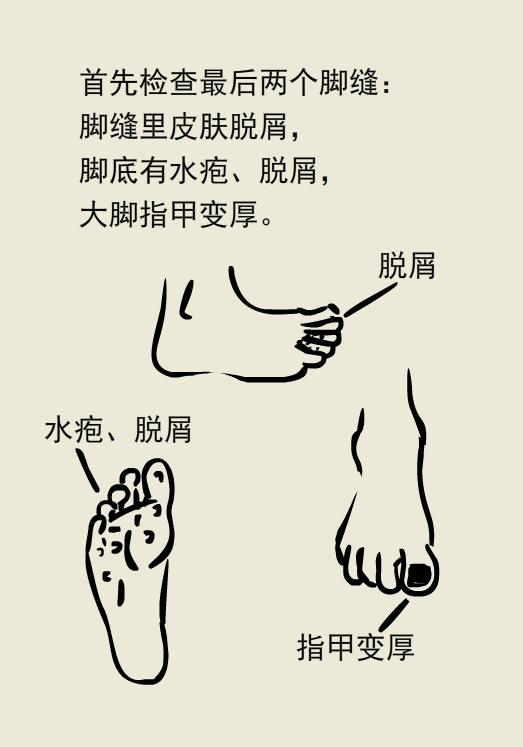 不臭不痒的脚气病,只痒无其他任何症状是脚气吗