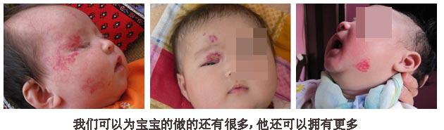 宝宝得了血管瘤妈妈要忌口吗,肝右侧实性结节血管瘤应关注什么