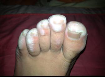 啥东西能治脚汗,什么东西可以止脚汗