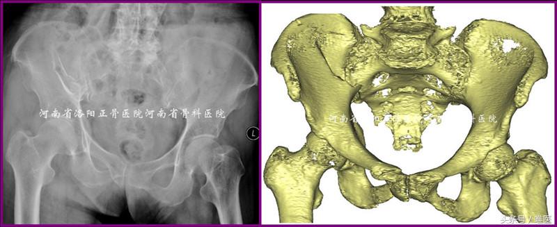 经皮置入术在骨盆髋臼骨折治疗中的应用骨医小灶第二十一期（中）