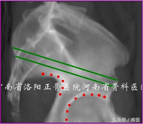 经皮置入术在骨盆髋臼骨折治疗中的应用骨医小灶第二十一期（中）