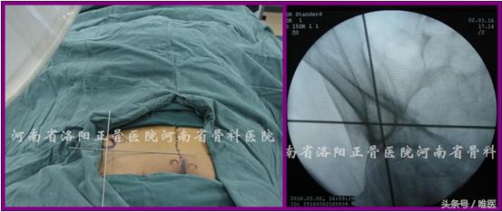 经皮置入术在骨盆髋臼骨折治疗中的应用骨医小灶第二十一期（中）