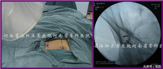 经皮置入术在骨盆髋臼骨折治疗中的应用骨医小灶第二十一期（中）