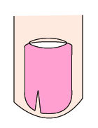 指甲出现白点、纵纹是怎么回事？