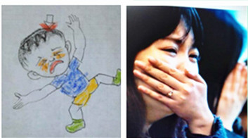 颅骨凹陷性骨折复位视频,儿童鼻骨骨折做手术是微创手术吗