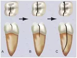 牙齿发酸流口水怎么回事,牙齿吃东西发酸发软怎么治