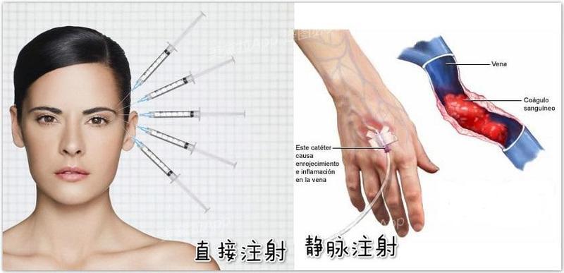 打美白针要知道哪些常识,打美白针要关注这些事项