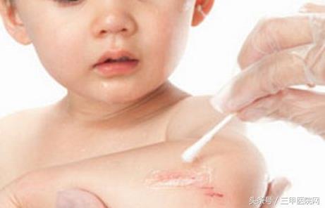 幼儿轻微外伤的处理方法,宝宝意外受伤正确处理方法