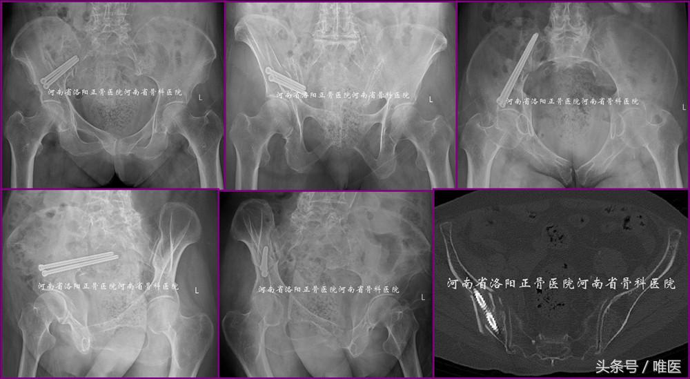 经皮置入术在骨盆髋臼骨折治疗中的应用骨医小灶第二十一期（中）