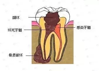 牙齿发酸流口水怎么回事,牙齿吃东西发酸发软怎么治