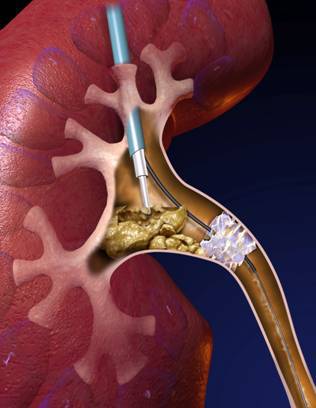 微创肾镜下肾结石碎石取石术,经皮肾镜肾结石激光碎石全过程