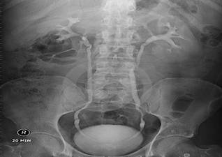 微创肾镜下肾结石碎石取石术,经皮肾镜肾结石激光碎石全过程