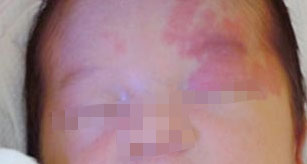 胎记、血管瘤治疗方式很重要！