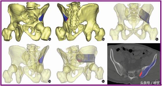 经皮置入术在骨盆髋臼骨折治疗中的应用骨医小灶第二十一期（中）