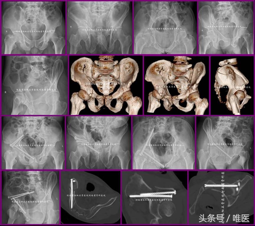 经皮置入术在骨盆髋臼骨折治疗中的应用骨医小灶第二十一期（中）