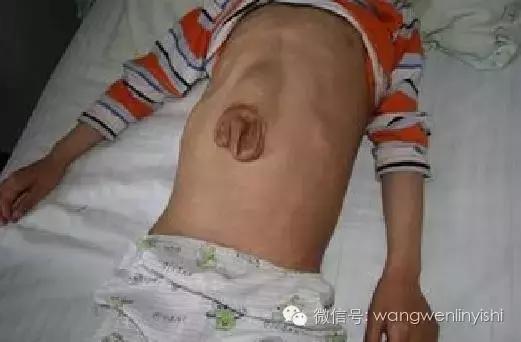 图与真相：什么是胸骨裂？