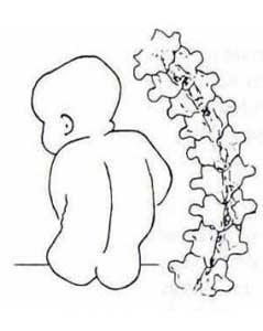 两岁宝宝有点驼背如何纠正,两岁宝宝驼背图片