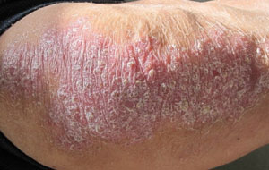 长期保湿有助于牛皮癣的恢复吗,有关牛皮癣常识的详细介绍