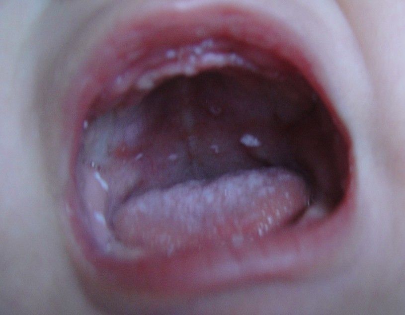 宝宝口腔里有白色奶块还酸味,宝宝口腔里有白色奶状物