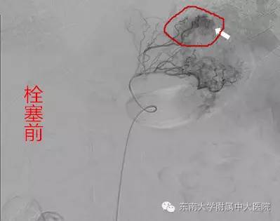 栓塞治疗有没有副作用,减肥后下肢静脉栓塞能改善吗