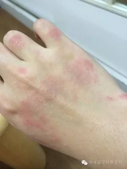 痒痒难受且看小手套大学问