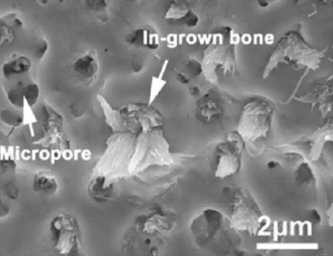 北医三院首例3d打印脊柱怎样了,3d打印助力攻克骨科难题